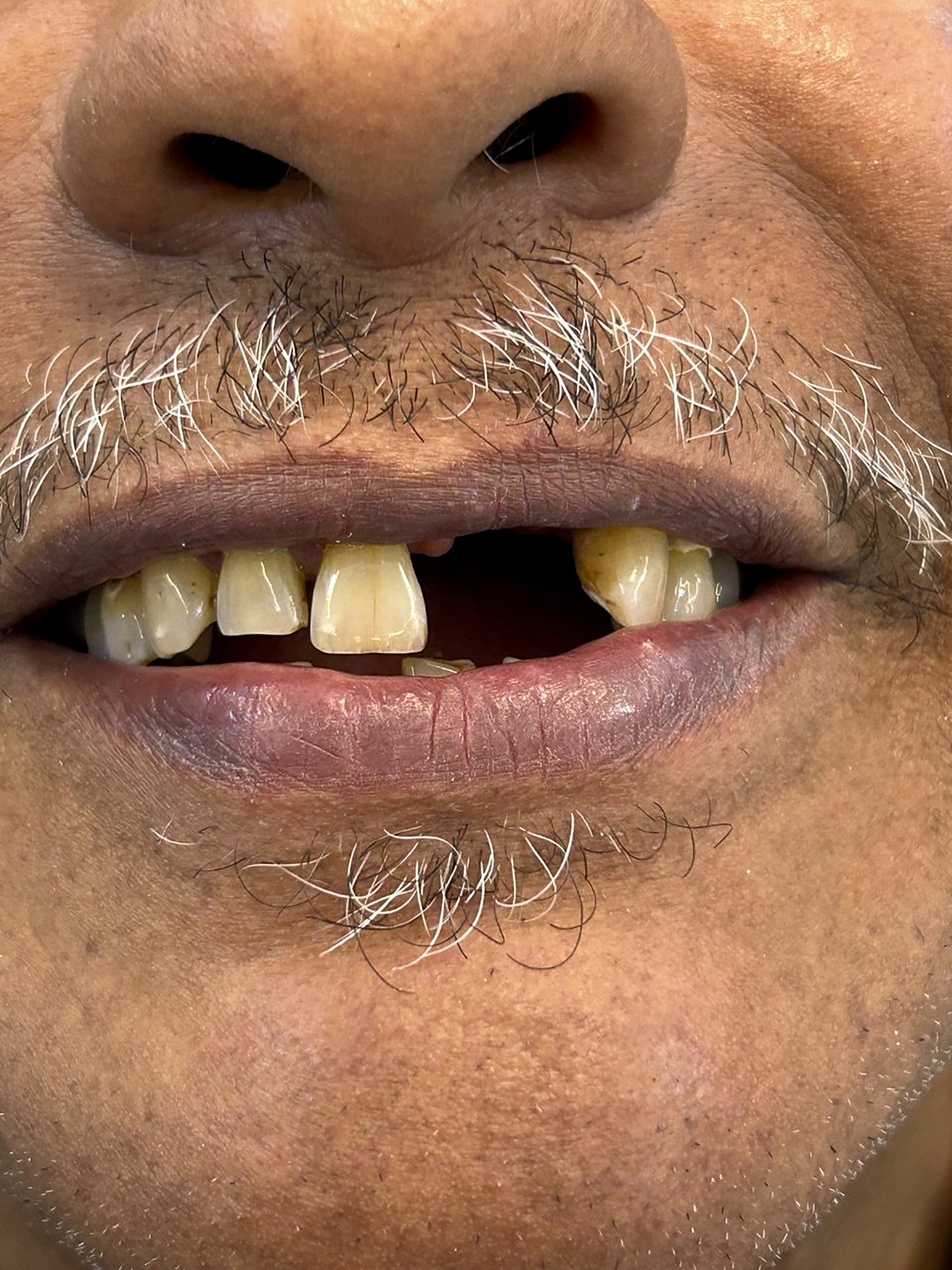 Avant traitement : dents antérieures manquantes, Centre Dentaire Harmony Tanger
